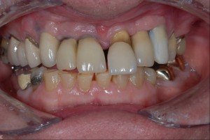 patient med mulig begyndende parodontose