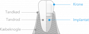 En tandkrone påsættes et implantat, hvilket kan betragtes som et samlet og professionelt tandimplantat