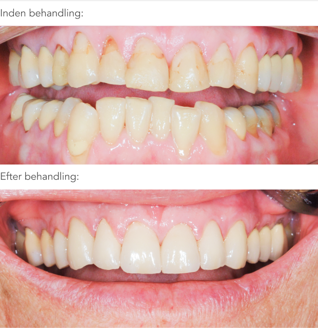 Før og efter tandretning