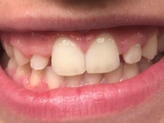 Invisalign 2 Før - Vejen til et smukt og naturligt smil