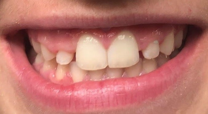 Invisalign 2 Før - Vejen til et smukt og naturligt smil