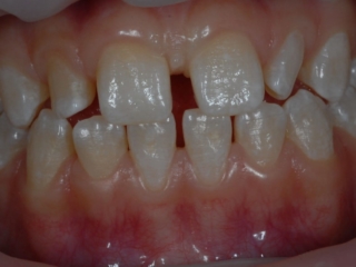 Invisalign 3 Før - Få rettet tænder på en skånsom måde