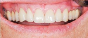 tænder hvor der kan være foretaget tandblegning og er et hvidere resultat